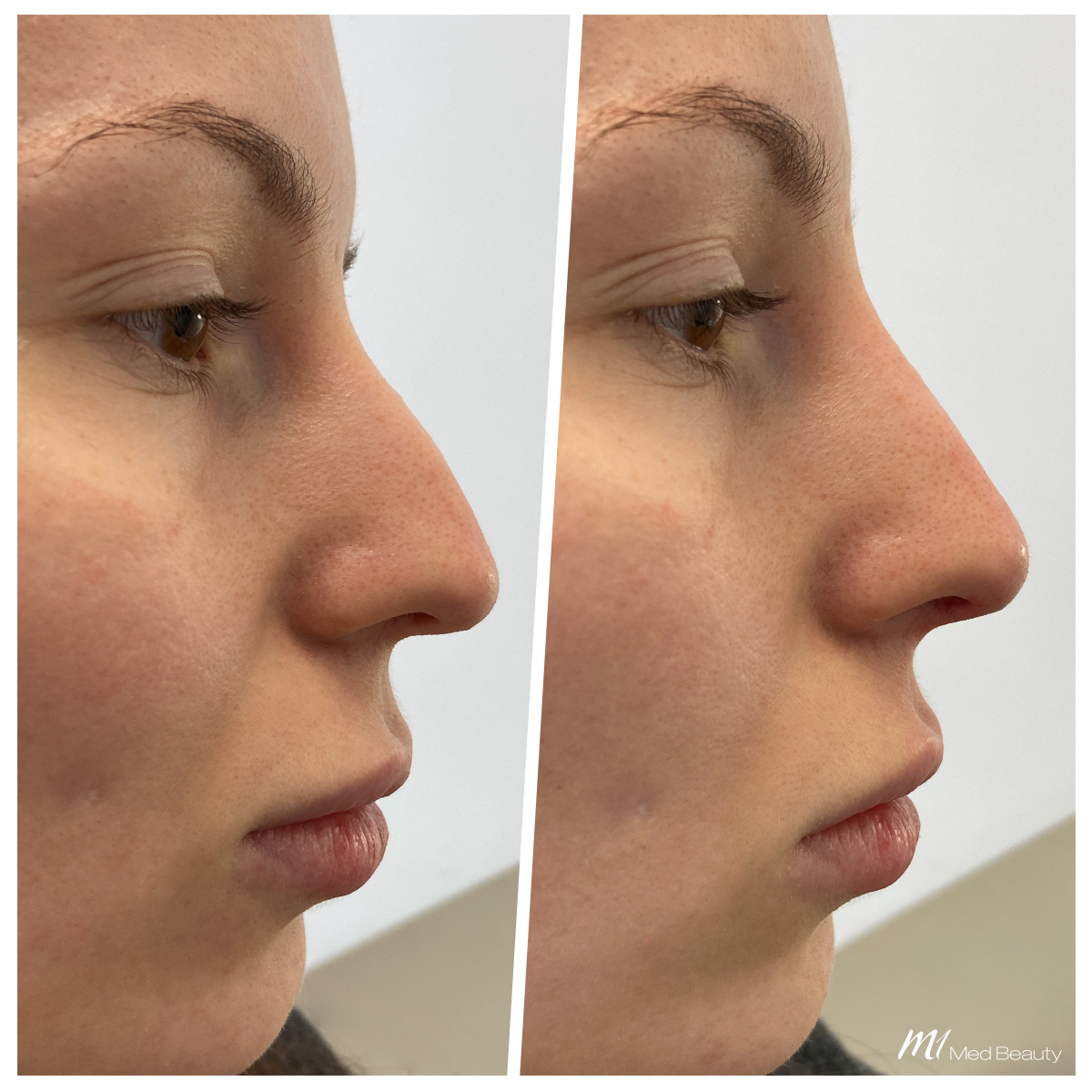 Vorher-/Nachher-Fotos einer Nasenkorrektur mit Hyaluronsäure.