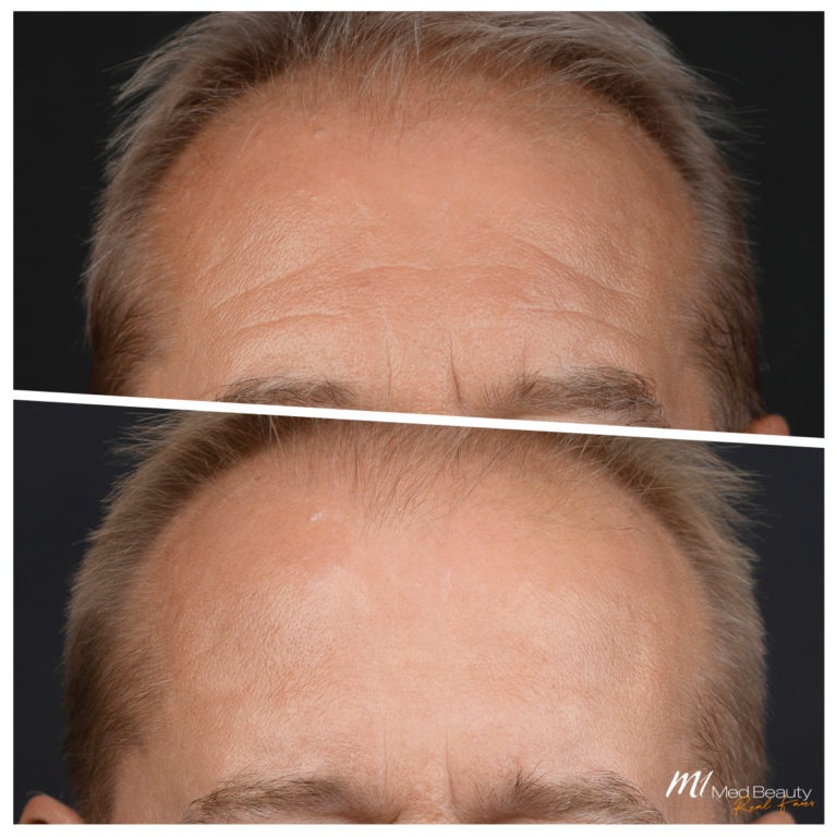 Stirnfalten entfernen mit Muskelrelaxans